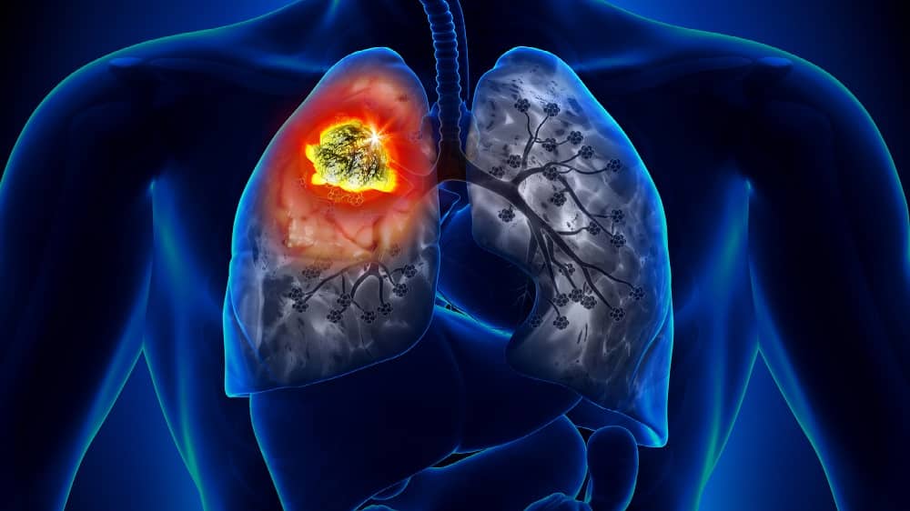 Sul Informação - Sociedade de Pneumologia defende diagnóstico precoce e rastreio ao cancro do pulmão