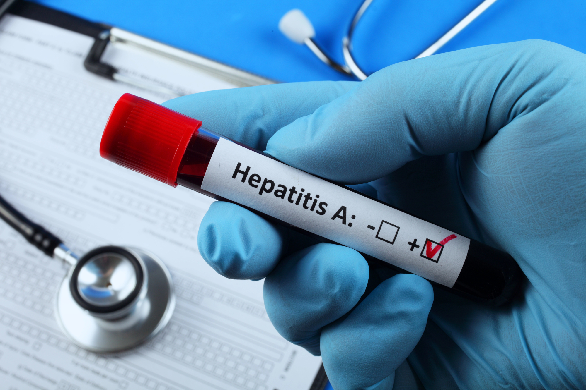 Sul Informação - Há um surto de Hepatite A no Algarve e no Alentejo, afetando sobretudo crianças, alerta a DGS