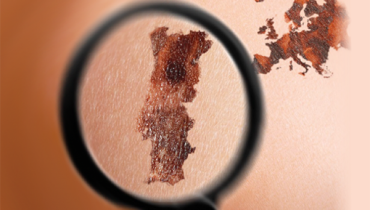 mailing_euromelanoma